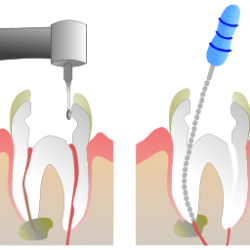 640px-Root_Canal_Illustration_Molar.svg_