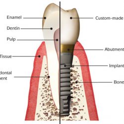 Implant